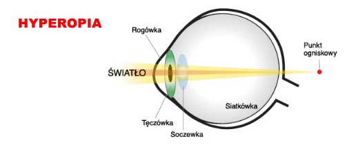 Optyk Katowice dalekowzroczność Hyperopia